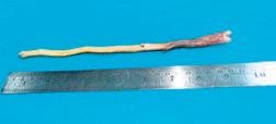Docs remove tooth stick from food pipe