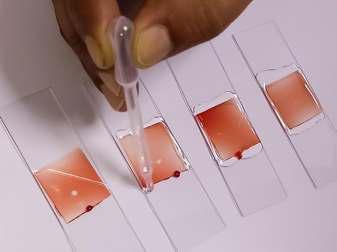 Scientists Develop Validate Scale To Measure Stigma In Patients With Sickle Cell Disease