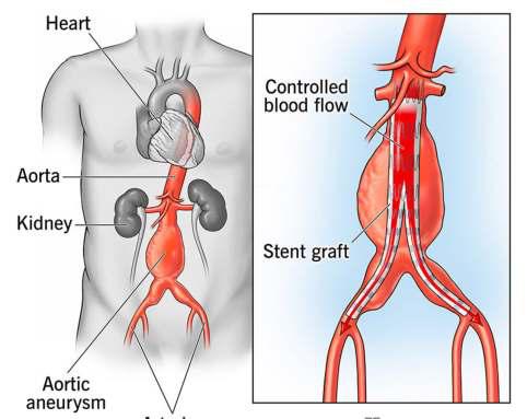 Ground-breaking Medical Procedure EVAR Performed At GMC Sgr