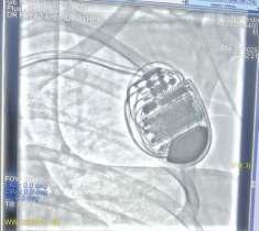 Paras Performs Life-Saving CRT-D Procedure On Brazilian Patient