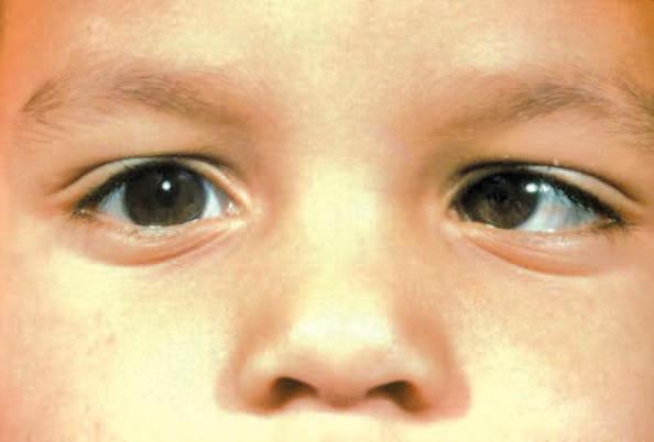 The Rise of Childhood Myopia