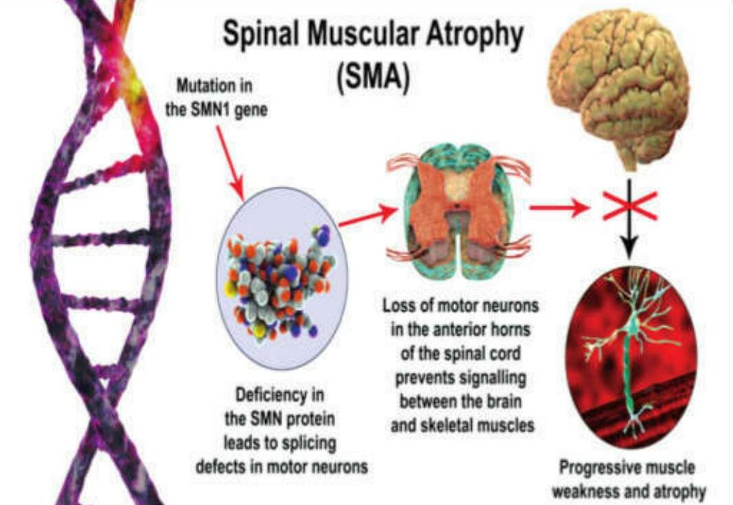 Boy gets Rs 17cr life-saving gene therapy for rare SMA type 1
