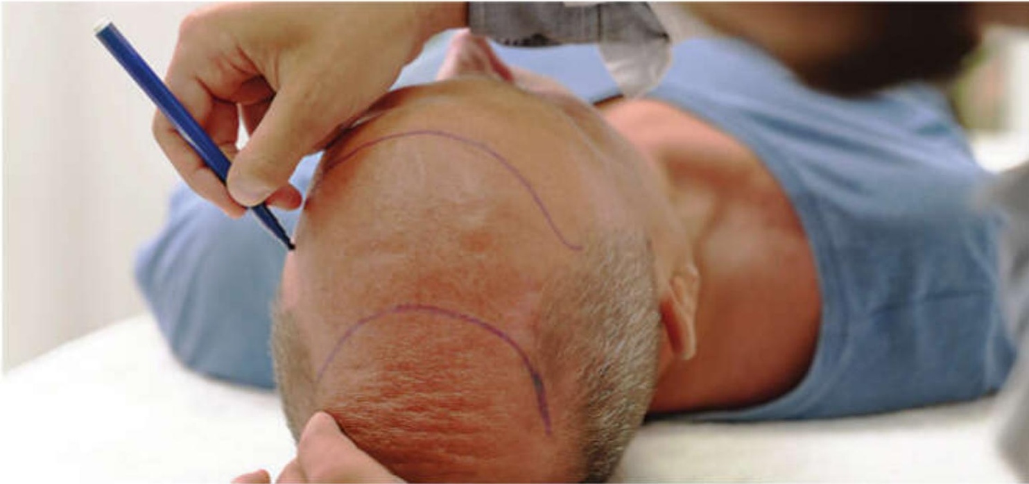Rethinking hair transplant: A call for greater awareness in cosmetic wellness