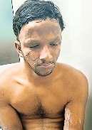 वेस्टर्न टायलेट सीट फटने से युवक घायल