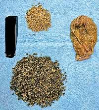 70 वर्षीय बुजुर्ग के गाल ब्लैडर से निकले छोटे-छोटे 8,125 पत्थर