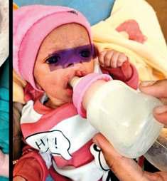 पहली बार बच्चे के तालु से जुड़े अविकसित भ्रूण को किया अलग