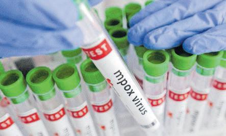 Namibia declares Mpox outbreak, confirmed case in Swakopmund