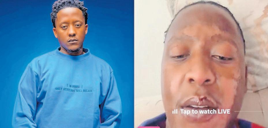 How cooking accident left actor Molekoa scarred but strong