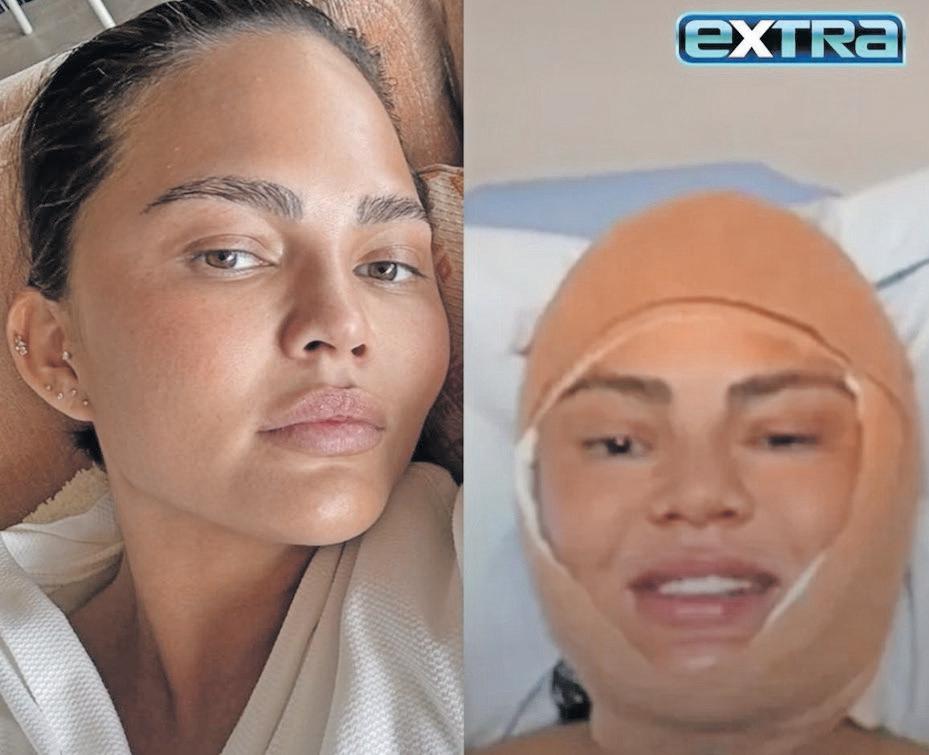 Chrissy Teigen's hairline makeover: what you need to know about this trendy procedure