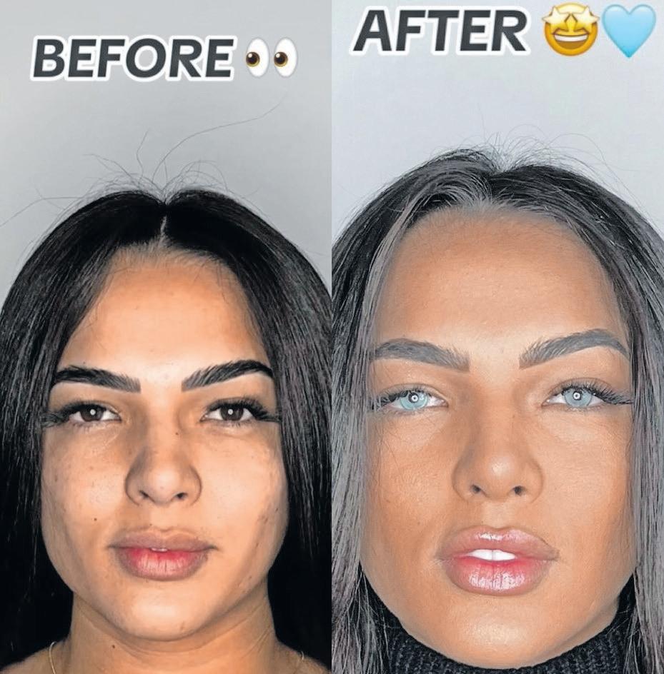Eye-popping risks: what you should know about cosmetic eye colour surgery