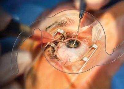 Overberg patients receive life-changing cataract surgery