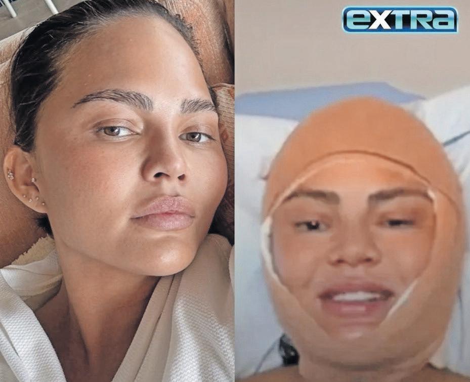 Chrissy Teigen's hairline makeover: what you need to know about this trendy procedure