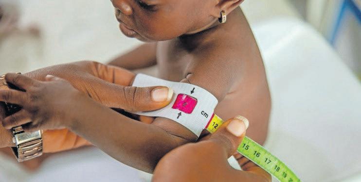 Malnutrition, not sugar, causes type 5 diabetes