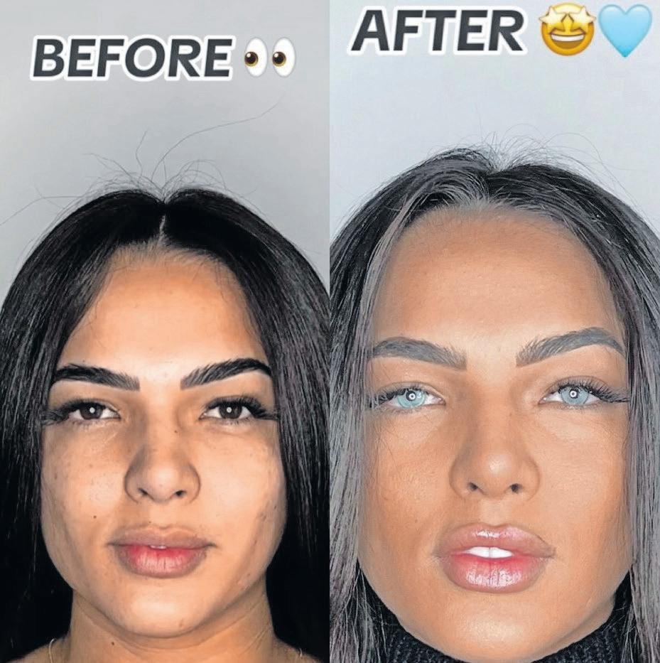 Eye-popping risks: what you should know about cosmetic eye colour surgery