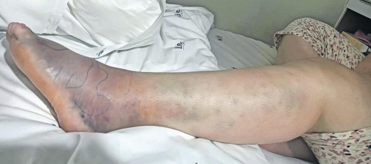 Woman survives puff adder bite