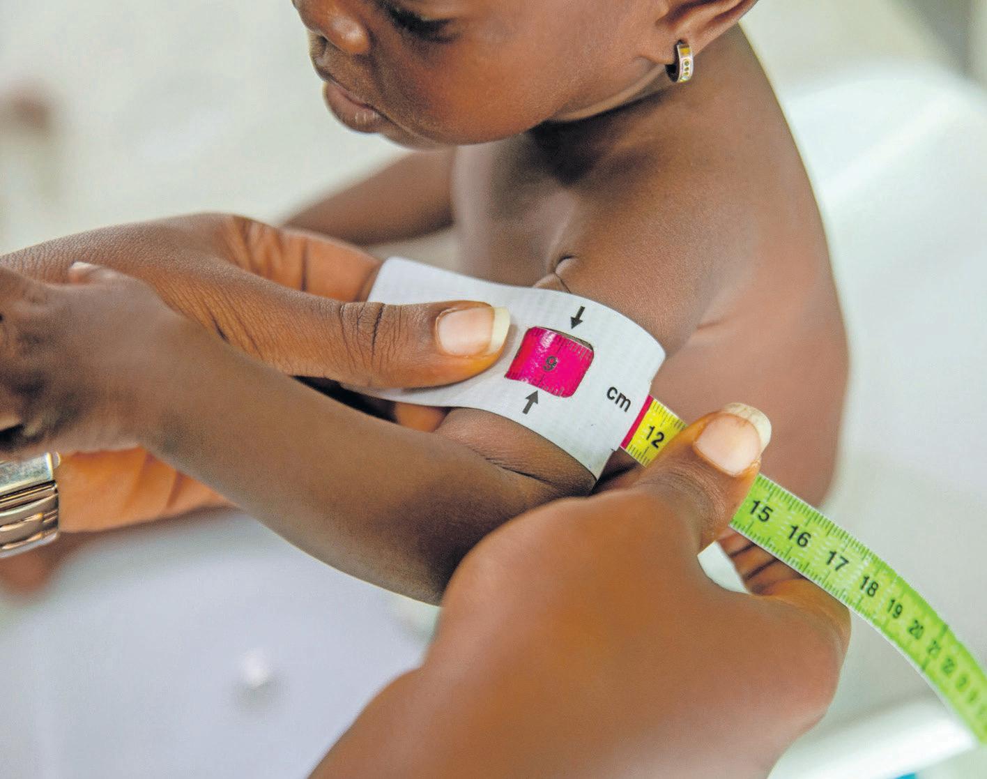 Spotting severe malnutrition in children: essential tips for parents