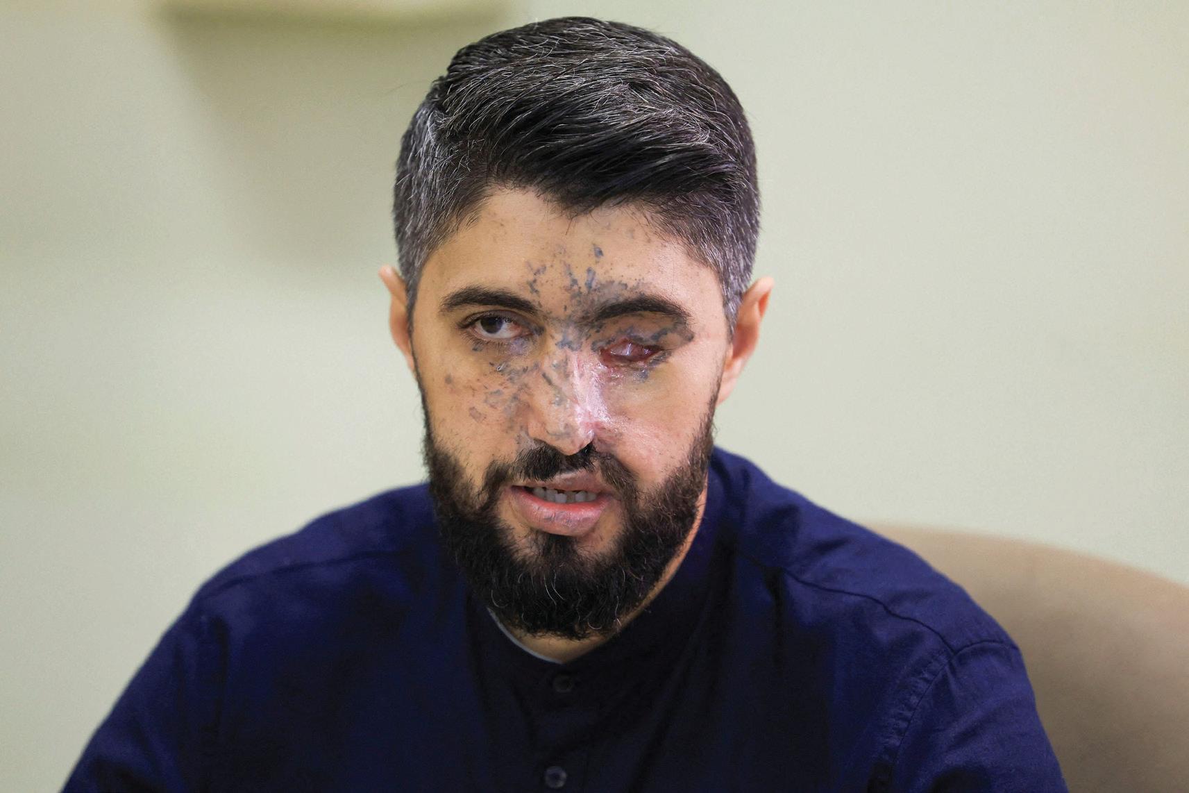 A year on, Lebanese maimed in Israel's pager attacks on long road to recovery