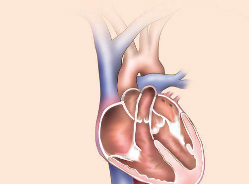 New, less invasive procedure to solve blockages in mechanical heart pumps