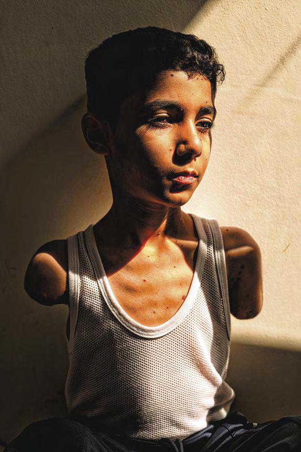 Image of Palestinian boy who lost both arms wins World Press Photo of the Year