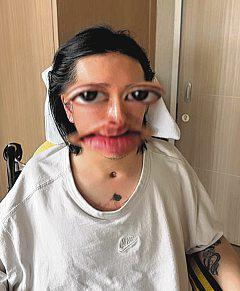 Dancer Lee Kai Yin shares first photo of his face since Mirror accident