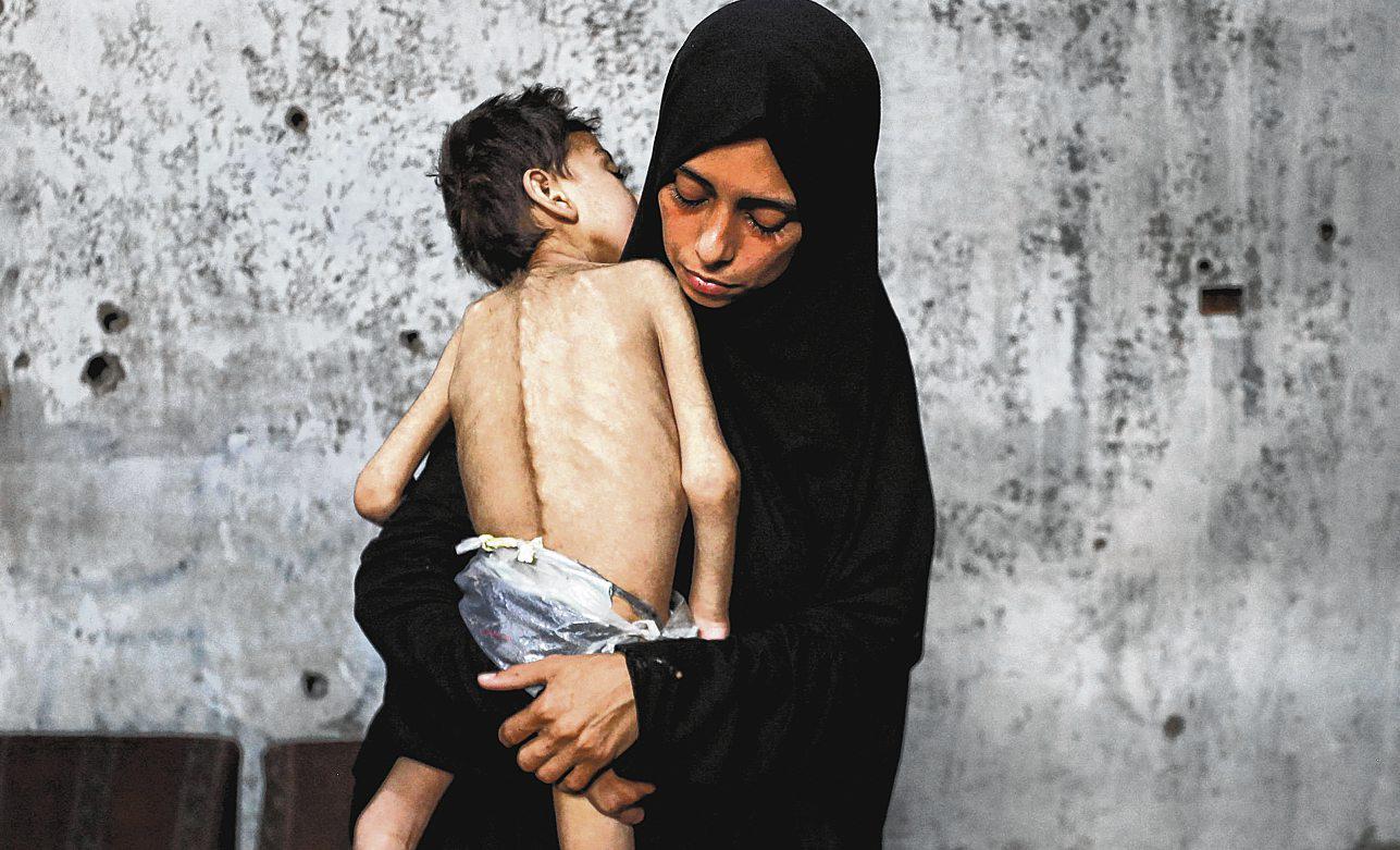 Gaza Running Out of Specialized Food to Save Malnourished Kids