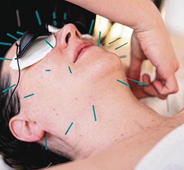 In the age of #notox, can cosmetic acupuncture be the new Botox?