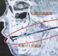 Brain injury's not slapstick for hurt boy