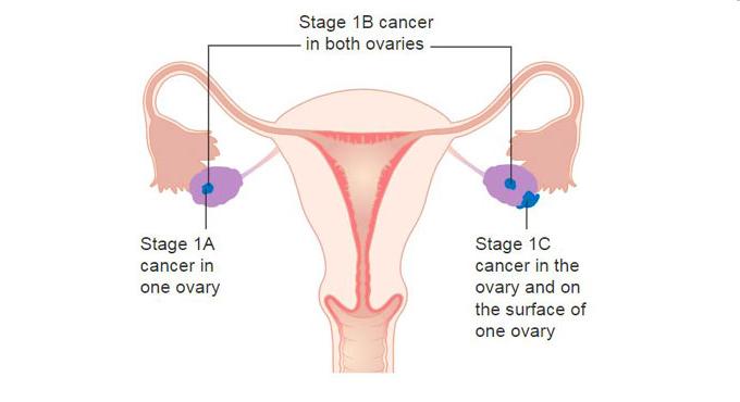 Potential therapeutic target identified for ovarian cancer