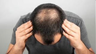 Kanpur engineers die after botched hair transplant: What questions should you ask your dermatologist?
