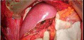 Liver expert shares pic of ‘weekends only’ alcohol drinking man’s liver; find out how having it even once a week can affect you