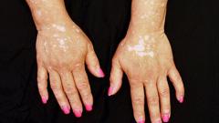 Towards empowerment: busting myths around vitiligo