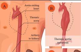 All you need to know about: aneurysms