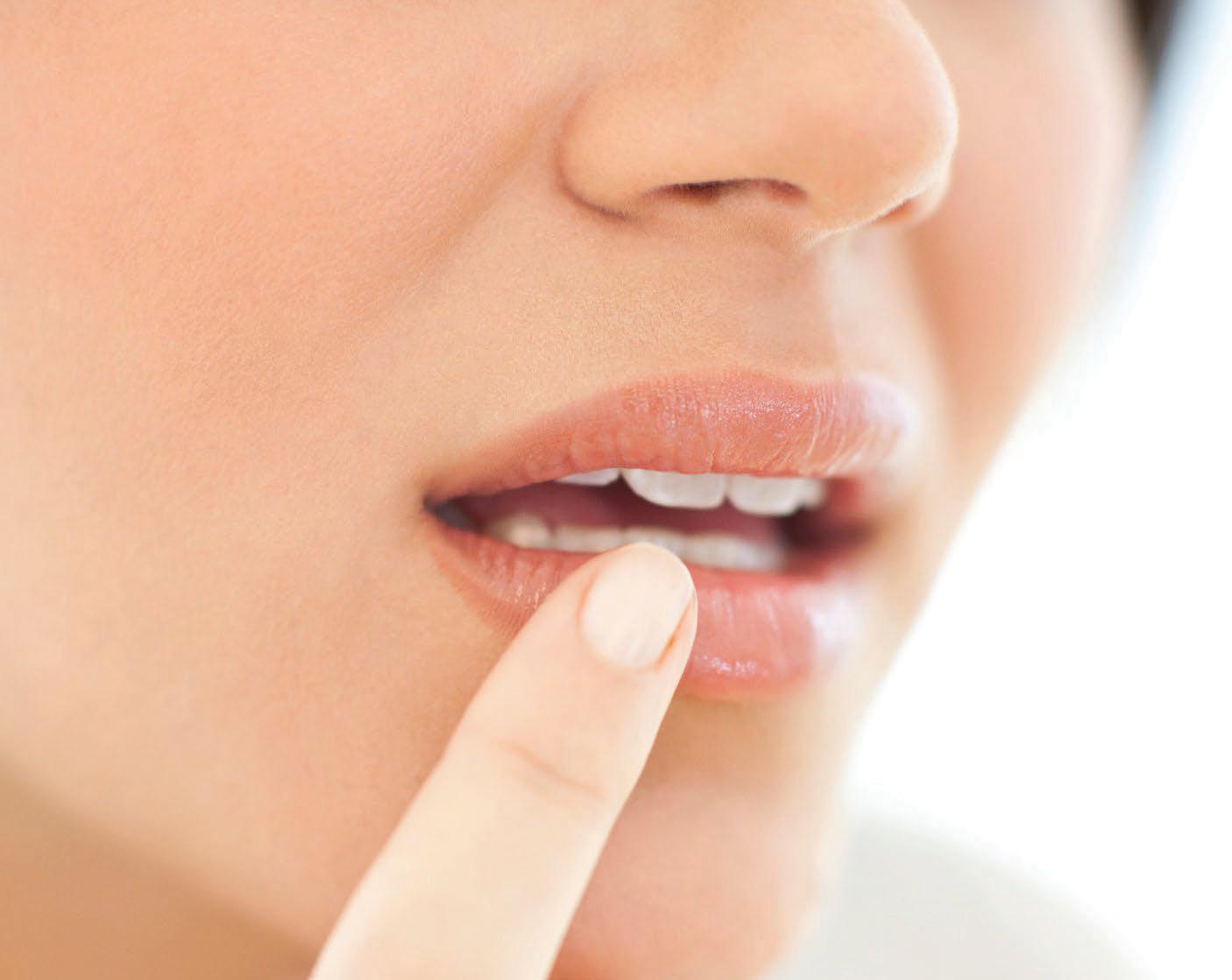 6 ways to zap that COLD SORE