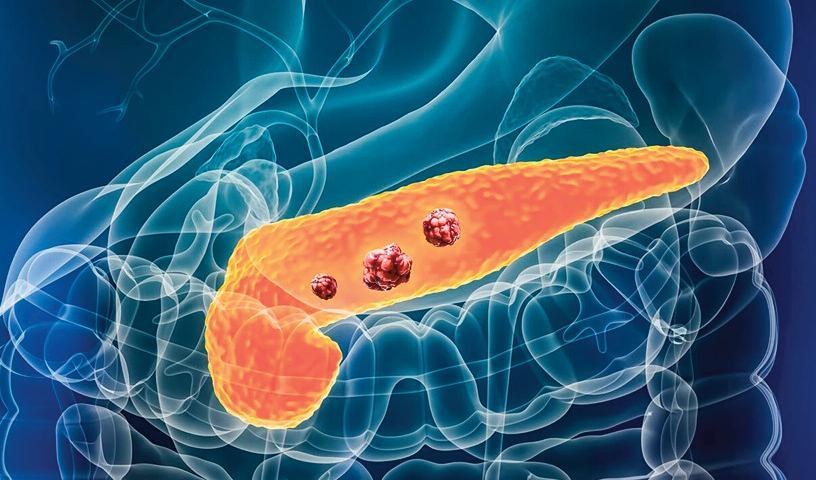 ప్యాంక్రియాటిక్ క్యాన్సర్ బాధిత రోగులలో అత్యవసరంగా అవగాహన మెరుగు