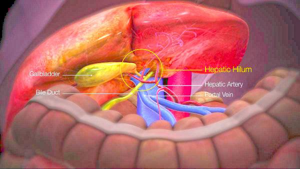 THE RISKS OF UNDIAGNOSED GALL BLADDER STONES: DOCTORS CALL FOR AWARENESS, TIMELY TREATMENT