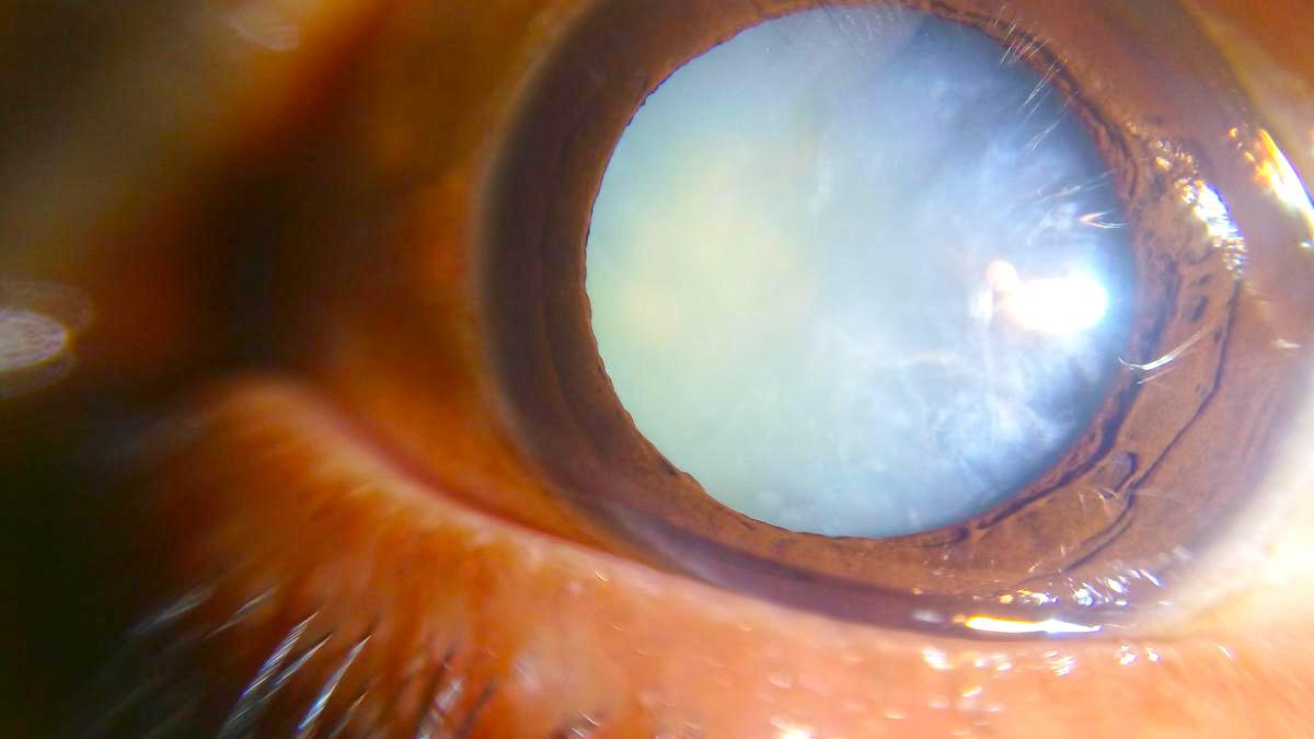 UNDERSTANDING CATARACTS AND THE SURGERY TO TREAT THEM