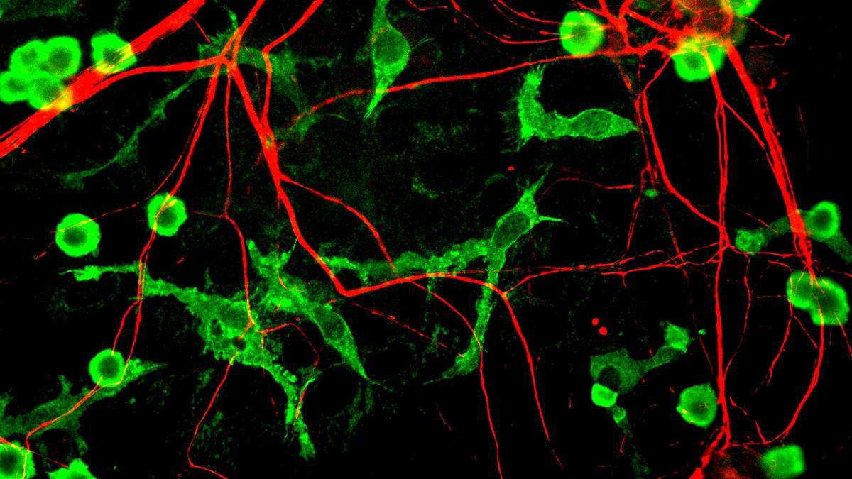 IMMUNE CELLS' FAT BLOCKS BRAIN'S ABILITY TO CLEAN ALZHEIMER'S PLAQUES