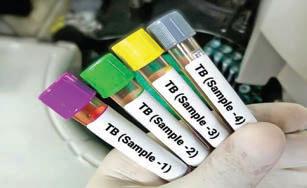 Made-in-India TB diagnostic tests validated by ICMR; offer cheaper, faster detection