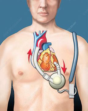 India to develop artificial heart to help transplant patients