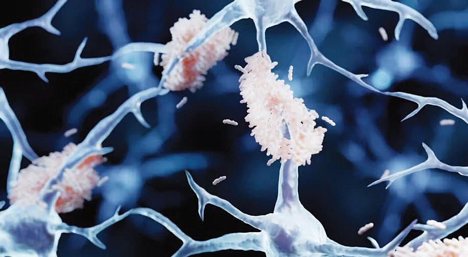 Early-onset Alzheimer’s: New drug shows promise in slowing the disease