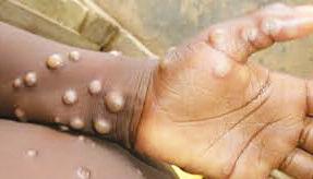 WHO says mpox no longer a global public health emergency