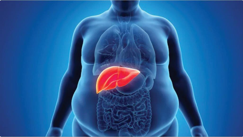 WHY INDIA IS NOW AMONG THE WORLD’S TOP THREE FOR FATTY LIVER DISEASE