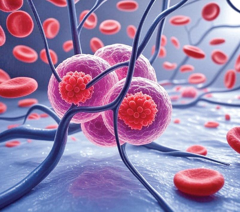 Late Diagnoses, High Costs Driving Blood and Bone Marrow Cancer Cases