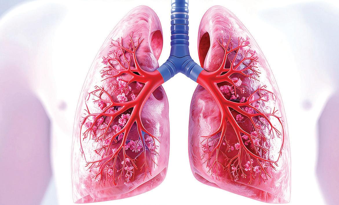 Lung cancer: First trial of antibody drug promising