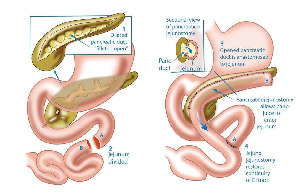 Hidden Tumor Causing Pancreatitis Removed in High-Risk Life-Saving Surgery