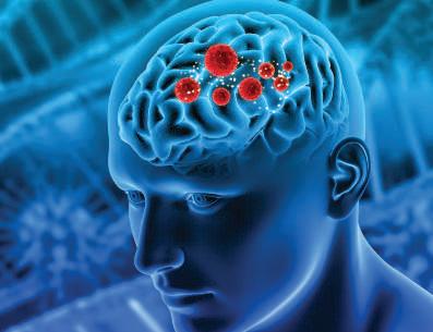Busting Common Myths About Brain Tumours