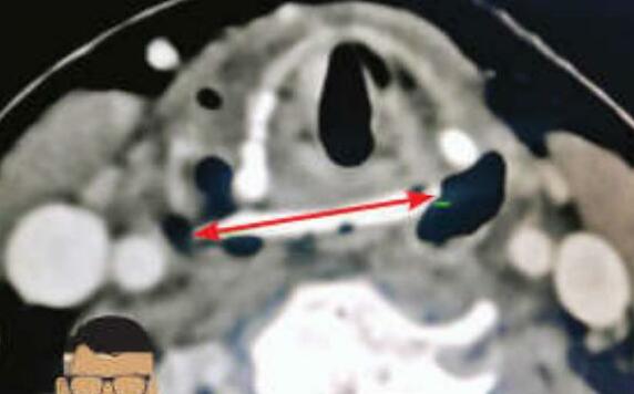 गले में फंसी चिकन की हड्डी नाक के पिछले हिस्से से निकली