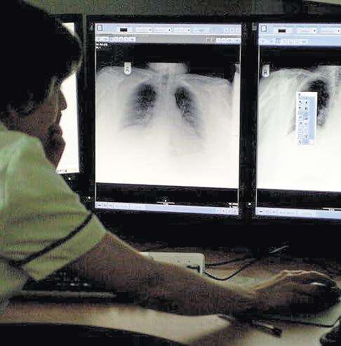 Calls for a public health strategy to combat rise in tuberculosis