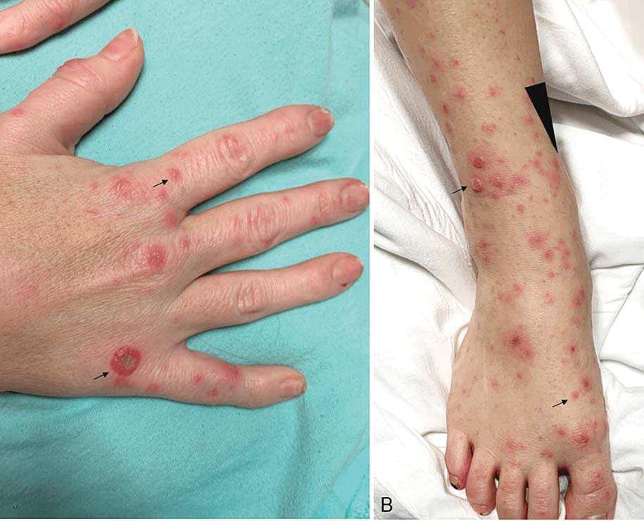 எலிக்காய்ச்சல் பரவல் தீவிரம்: பொது மக்கள் அவதானத்துடன இருப்பது அவசியம்