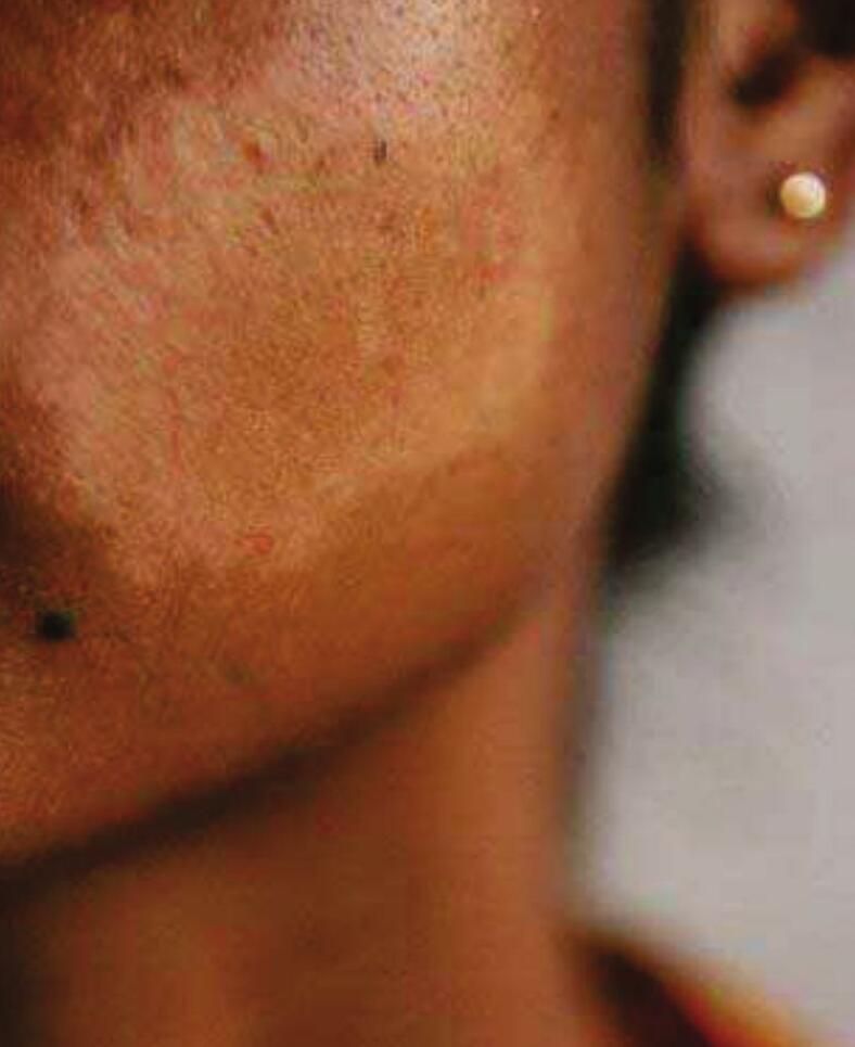 தொழுநோய் ஏற்படுவதற்கான காரணங்கள்